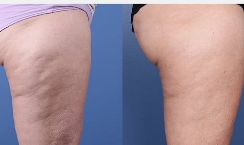 rf cellulite treatment before after results